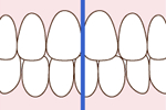 上の前歯と下の前歯の真ん中がずれている