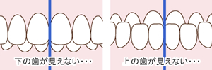 下の前歯が半分以上、上の前歯に隠れている（またはその逆）