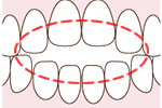 上の前歯と下の前歯のすき間が５ミリ以上ある