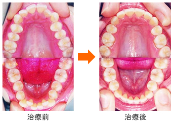 抜歯矯正の治療例