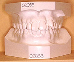 歯型の模型